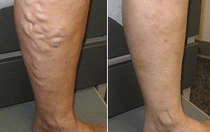How To Get Rid Of Varicose Veins