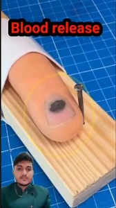 Nail hematoma #hematoma #nailcare #bloodhematoma
