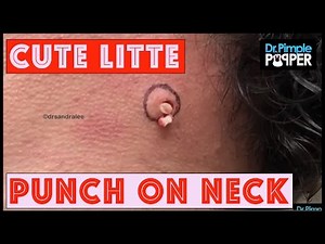Cyst and a Punch: With Dr Pimple Popper