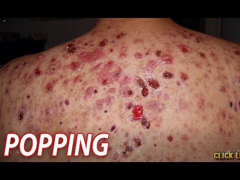 Severe Back Acne! What is Bacne?