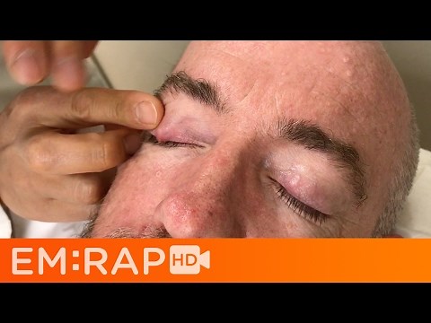 Chalazion Injection