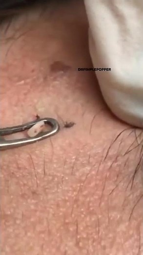 The Most Satisfying Steatocystoma Pop