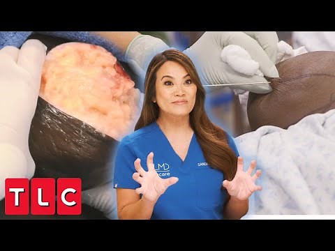 Dr. Lee Removes a Gigantic Knob From Patient’s Butt! | Dr. Pimple Popper