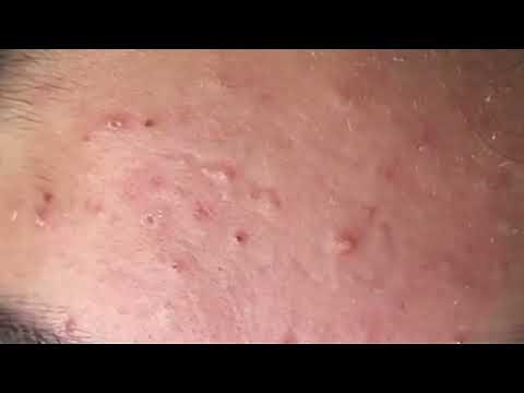 *Remove Very Old Blackheads on Face | Effective Blackhead Removal Routine* ‪@removeblackhead‬