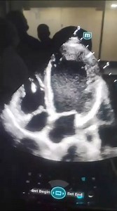 45 yrs female syncope, long QT, torsades, chb... Worst phenotype of takotsubo. | Cardiophilia