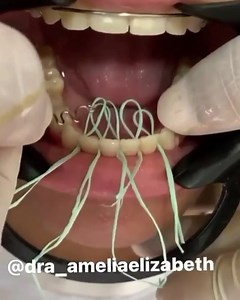 Placing a lingual retainer with floss 醴 . . Case by @dra_ameliaelizabeth #teeth#tooth#toothless#extraction#cirugiabucal#oralsurgery#dental#dentist#dentistry#dentalschool#dentalstudent#dentalhygiene#implant#dentist#odonto#odontogram#odontologo#odontolove#odontología#odontologia#odontogram#odontoporamor#estomatología#prosthesis#prosthodontics#ortho#braces#smile#drawing | Dentistry blog | Facebook