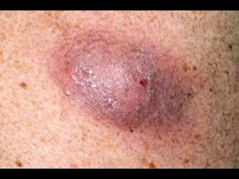 HUGE FACE CYST REMOVAL
