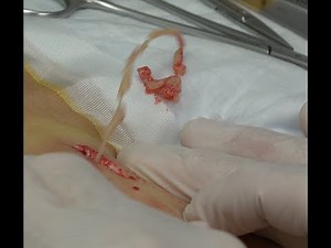 Bruce Infected Cyst, Double Super Slo-Mo!