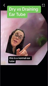 👂Ear Drainage with an ear tube can be normal. Ear tubes allow what would have been a traditional ear infection (with an intact ear drum) to a draining ear infection. So instead of the fluid/infection being stuck behind the ear drum, it is able to come out through the ear tube. The treatment in this case is antibiotic ear drops instead of antibiotics by mouth (usually).📝Comment below if that makes sense to you, or if you have had this before.#eartubes #drainingear #earinfection #eardischarge #k