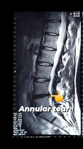 #Annular tear Most common unidentified pathology in "Disc " Where patient complaint about discogenic pain while in standing Position!! #MIPSI #jprcneurospine #painmanagementdoctor #painmanagementclinic #annular #discography #discogenic | JPRC Neuro Spine Centre | Facebook