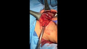 Lymph node dissection near axillary nerve - Checkpoint Surgical