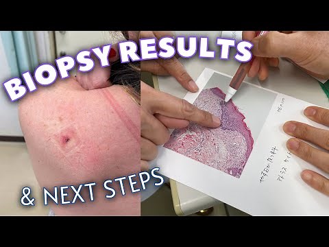 Biopsy Results, why I got my skin checked, and what happens next! | BASAL CELL CARCINOMA