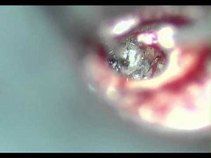 Stapedectomy conducted by Richard J. Weit - Otosclerosis