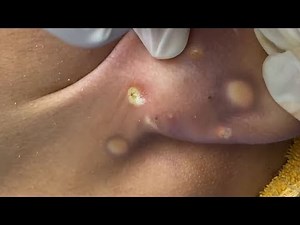 Big Cystic Acne Blackheads Extraction Blackheads & Milia Whiteheads Removal Pimple Popping 9