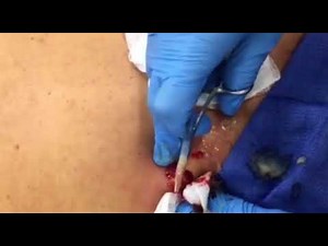 Best abscess explosion pus
