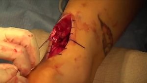 Achilles Tendon Repair