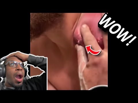 LOOK AT HIS SHOULDER, THAT IS INSANE! | Pimple Popping and Blackhead Compilation