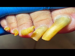 Extremely Long Toenails, Perfectly Trimmed Onychomycosis~【Pedicure King】