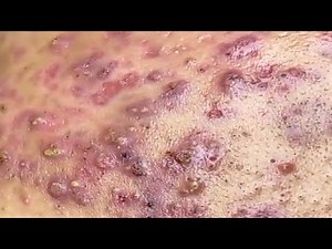 Part 2 "Massive Acne Breakout Cleanup & Blackheads Removal | Real Skin Recovery Journey"