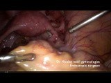 Rare Case of Genital Tuberculosis With Tubal Patency • Video • MEDtube.net