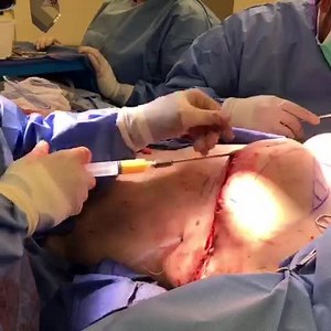 Fat Grafting to Breast Demonstration (GRAPHIC)