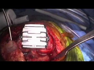 Standard Total Knee Replacement • Video • MEDtube.net