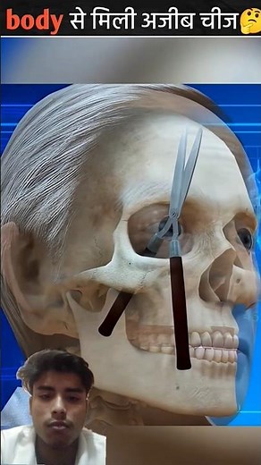 The strangest thing found in the body🤔