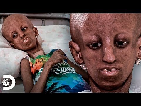 15-year-old girl ages rapidly and prematurely | My Body, My Challenge | Discovery Brazil