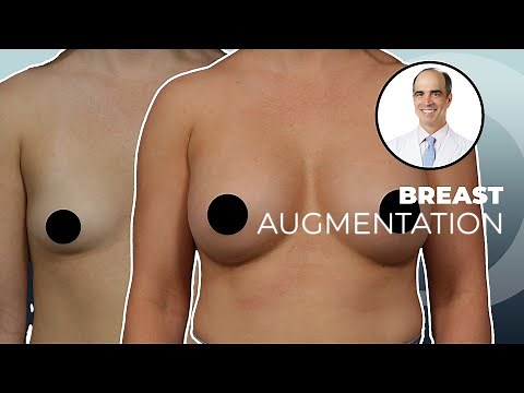 Rapid Recovery Breast Augmentation | Before & After | Dr. David Stoker