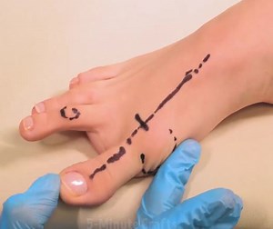 156K views · 786 reactions | Fascinating flat feet treatment processes! | 5-Minute Crafts | Facebook