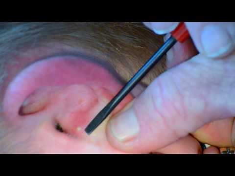 Painful Ear Pimple Popped and Slowly Pressured