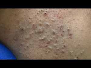 Deep Cleansing Techniques For Clear Pores — Best Blackhead Extraction
