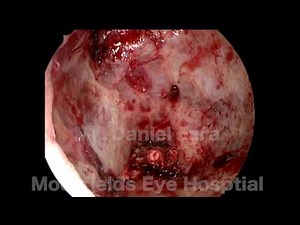Orbital Exenteration, Moorfields Eye Hospital Technique