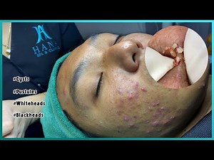 Big Cystic Acne Blackheads Extraction Blackheads & Milia, Whiteheads Removal Pimple Popping