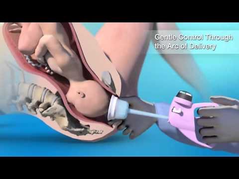 Vacuum Assisted Delivery featuring MityOne®