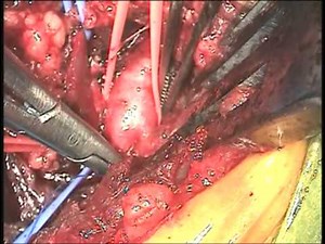 Surgical Technique: Direct Axillary Artery Cannulation (Arie Blitz, MD)