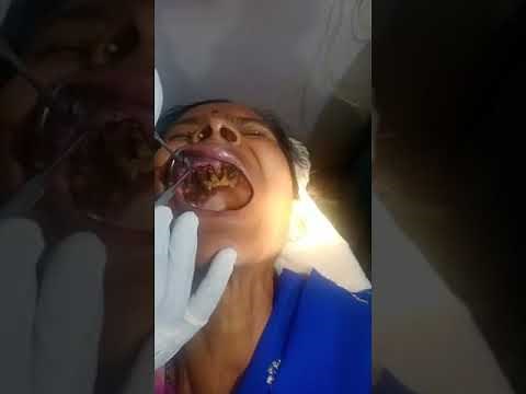 poor oral hygiene: worms inside mouth; a case from Chhattisgarh