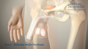 Tactra Malleable Penile Prosthesis Animation