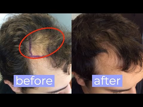 Fast results from PRP Treatment for HAIR LOSS