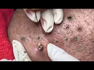 Popping huge blackheads and Giant Pimples- Best Pimple Popping Videos