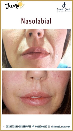 1.7K views | Injection d’acide hyaluronique pour les sillons...