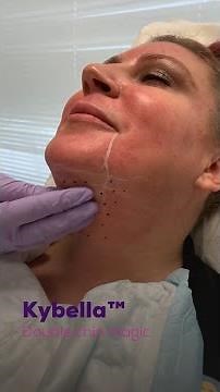 Kybella - Double Chin Treatment