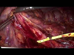 Lap Subtotal Colectomy with Antiperistaltic Cecorectal Anastomosis in Slow Transit Constipation