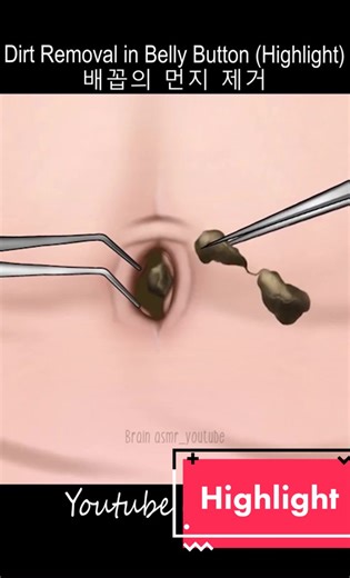 Deep Belly Button Dirt and Stone Removal ASMR Animation