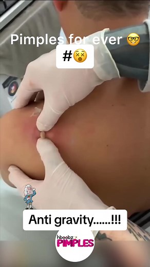 #pimple #medical #horror #blackhead #bigpimple #pimpleremoval #disgusting #pimplepop #cystexplosion #squeeze #squeezeyuk #skincare #acnetreatment #acne #pimples #satisfying #abscess #verysatisfying #whiteheads #cyst