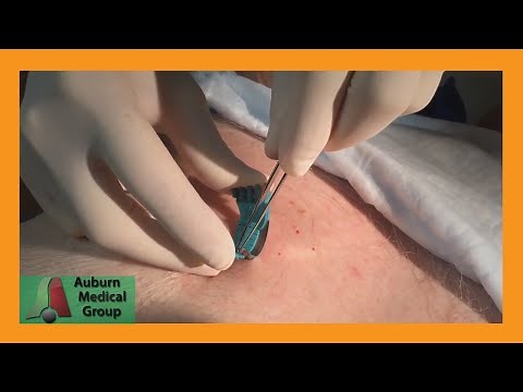 Abdominal Skin Lesion Shave Biopsy