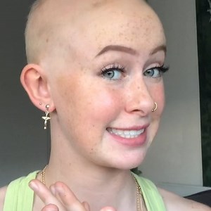 StuffThatWorks on Instagram: "One of the alopecia community members on StuffThatWorks is sharing her story with us. Join the almost 3K members and see what treatments helped others with alopecia and also contribute to the knowledge base by sharing your own experiences.  Link in our Bio . . . . . #alopecia #alopecianbeauty #experience #warrior #chronicillness #disease #alopeciafighter #share #treatment #research #community #member #effective #health #data #ai #stuffthatworks"