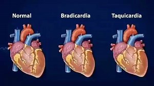 Bradycardia Vs Tachycardia . . . ❤️Love to TAG & SHARE @@doctordconline . . . #video #instavideo #heart #cardiology #cardiologist #ctvs #bradycardia #tachycardia #usmle #usmlestep1 #doctor #doctordconline #nhs #nurse #nursing #mbbs #md #medicine #medlife #medschool #medstudent @doctordconline | Doctordconline