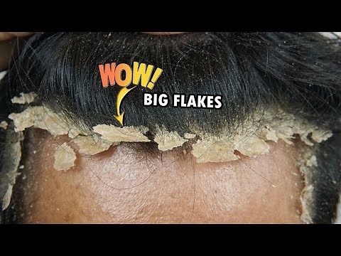 Itchy Dry Scalp Scratching Dandruff Satisfying #755