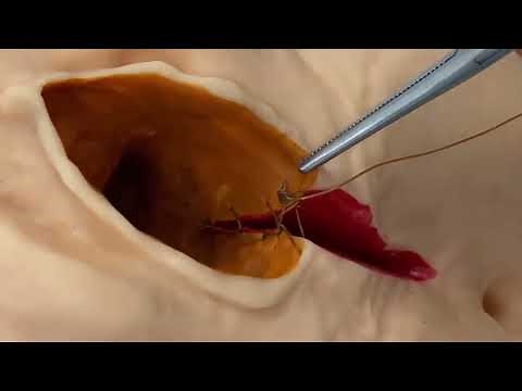Episiotomy & suturing procedure